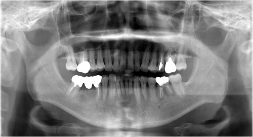 　篠崎1 GBR　初診時 ◎